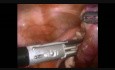 Salpingektomie bei Torsion der Tuba uterina