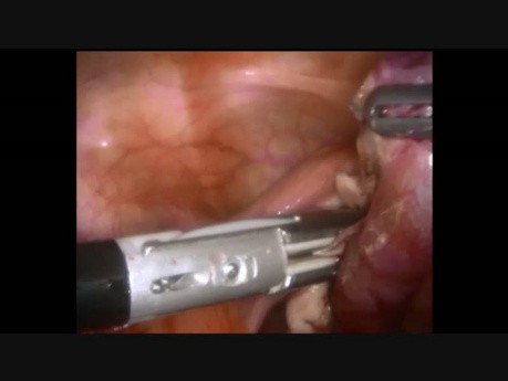 Salpingektomie bei Torsion der Tuba uterina