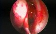 Die allergische fungale Sinusitis - endoskopische Behandlung
