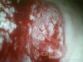 Zervikales Adenokarzinom (Carcinoma glandulare colli uteri)
