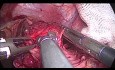 Laparoskopische Kardiomyotomie nach Heller und Fundoplikatio nach Dor