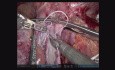Robotische Lebertransplantation von einem verstorbenen Spender