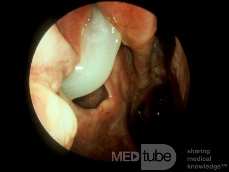 Antrostomie der unteren Meatus [rechts]