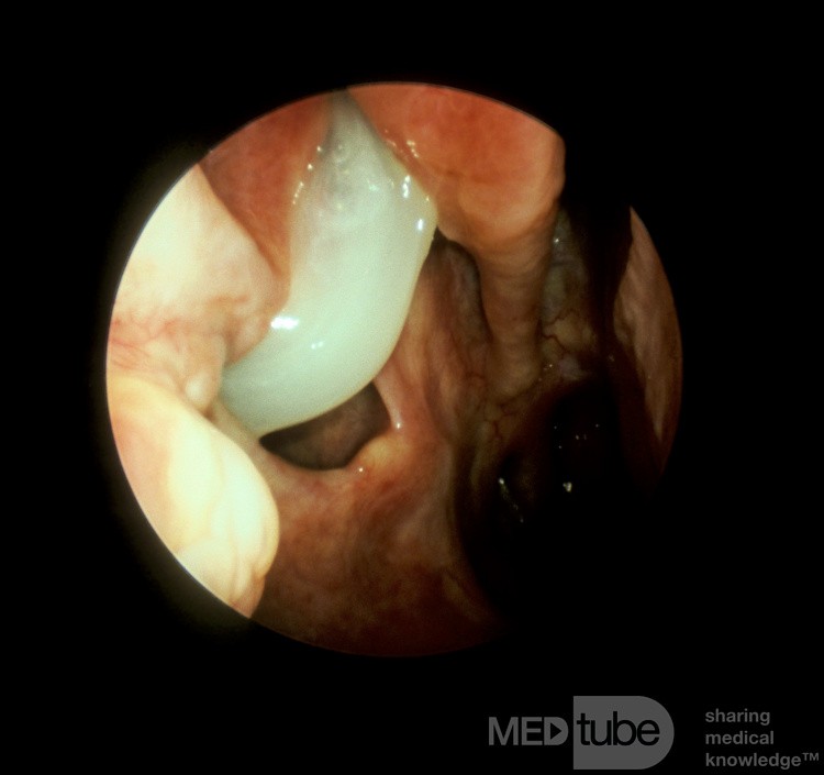 Antrostomie der unteren Meatus [rechts]
