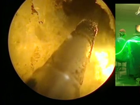 Greenlight-Laser zur Behandlung der Prostatahyperplasie