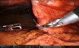 TAPP – Peritonealriss: horizontale Matratzen-Purse-String-Naht als Verschlusstrick