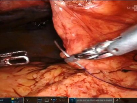 TAPP – Peritonealriss: horizontale Matratzen-Purse-String-Naht als Verschlusstrick
