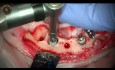 Implantatextraktion und Sofortimplantation kombiniert mit gesteuerter Knochenregeneration