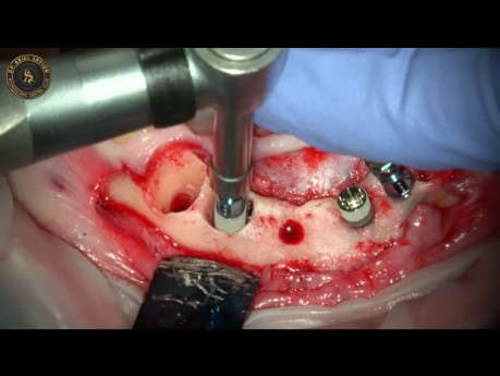 Implantatextraktion und Sofortimplantation kombiniert mit gesteuerter Knochenregeneration