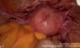 Chirurgie des Endometriumkarzinoms – Sentinel-Lymphknoten