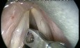 Unbeabsichtigter Ausriss eines Stimmlippenpolypen - Perfekte Exzision