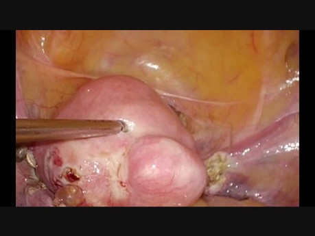 Hysterektomie- Dissektion der Arteria uterina