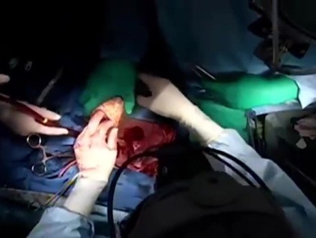 Herztransplantation mit Verstärkung der Anastomosen mittels Teflonfilz