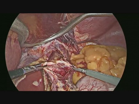 Laparoskopische Enukleation von Leiomyomen des Ösophagus