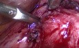 Prävention, Fehlerbehebung und Management von Komplikationen. Retroperitoneum und Harnwege.