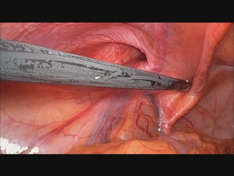 Anatomie der Leiste für laparoskopische Operationen