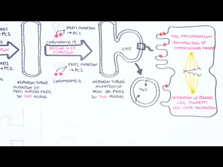 Polyzystische Nierenerkrankung (autosomal dominant) – Ursachen, Pathophysiologie, Behandlung