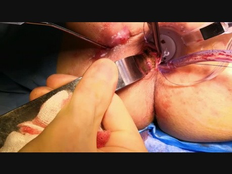  Analfistelchirurgie mit dem LIFT-Verfahren 