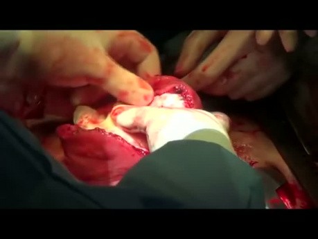 Myomektomie. Entfernung großer Myome mit temporärem Clipping von Uterusarterien