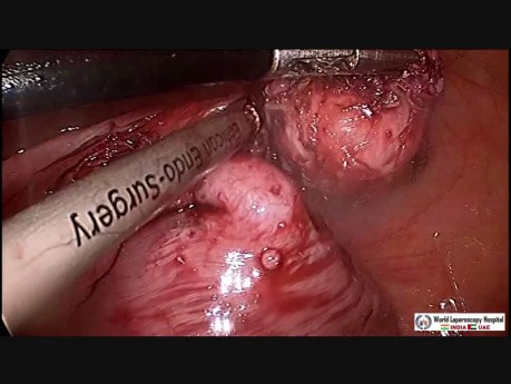 Die laparoskopische Myomektomie bei intramuralem Myom