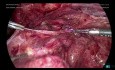Laparoskopische Enterolyse - Hydrosalpinx (4)