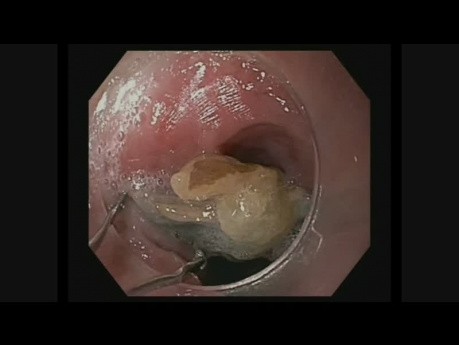Ösophagus-Fremdkörperentfernung im oberen Gastrointestinaltrakt