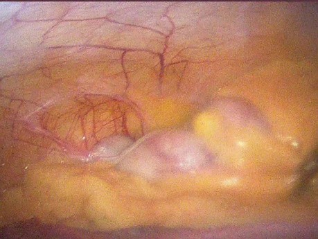 Akute Appendizitis in der Schwangerschaft mit rechtsseitiger schräger Leistenhernie und vorheriger Laparoskopischer Cholezystektomie (Gallenblasenentfernung).