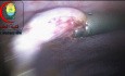 Die Bergung eines resezierten Appendix über einen Trokar