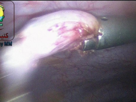 Die Bergung eines resezierten Appendix über einen Trokar