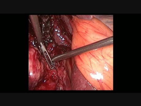 Cholezystitis
