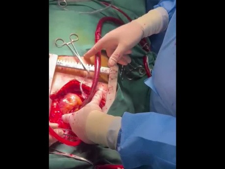 Postmortale Organspende nach vollständigem Herzversagen mit der Zeraatian-Technik
