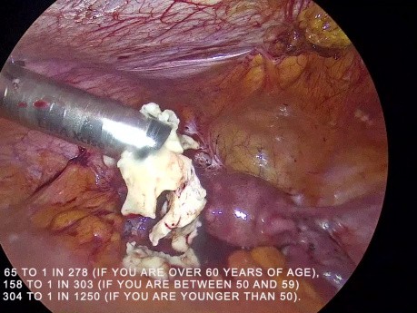  Begrenzte versus unbegrenzte Morcellation von Fibromen
