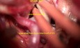 Komplexes Aneurysma der Arteria carotis interna – exoskopisch-mikrochirurgisches Clipping