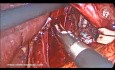 Laparoskopische Reparatur einer gleitenden Hiatushernie