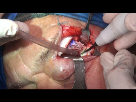 Primäre Rekonstruktion mit dem PEEK-Implantat der Fehlbildung der Venen im Mittelknochen des lateralen Randes der Augenhöhle