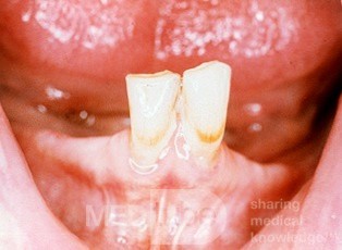 Unterkieferresorption