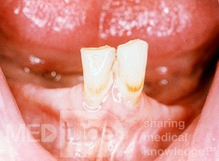 Unterkieferresorption