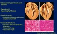 Echokardiographische Beurteilung der hypertrophen Kardiomyopathie (HCM)