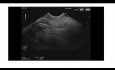 Endoskopischer Ultraschall der Papillenstenose