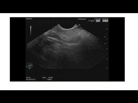 Endoskopischer Ultraschall der Papillenstenose