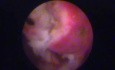 Großer Endometriumpolyp in die Menopause