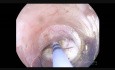 Tunnelentfernung eines submukösen Tumors der Ösophagogastrische-Verbindung (STER)