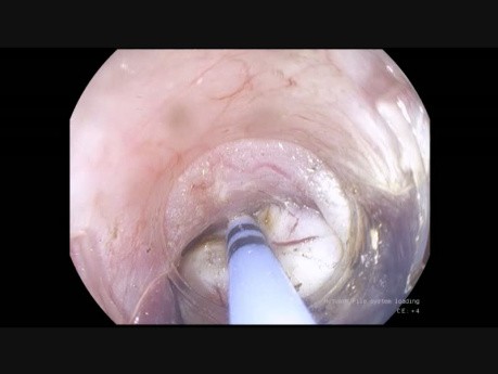 Tunnelentfernung eines submukösen Tumors der Ösophagogastrische-Verbindung (STER)