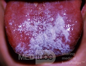 Leukoplakie [ Soorinfektion]