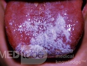 Leukoplakie [ Soorinfektion]