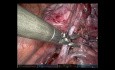 Anatomische Segmentektomie S7+8