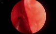 Komplette endoskopische Nasennebenhöhlenchirurgie