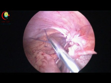 Intrakorporaler Knoten mit einem Instrument oder Shalaby-Ismail-Knoten bei der Reparatur angeborener Hernien bei einem 11 Monate alten Säugling