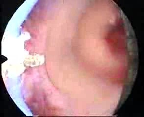 Intrauterine Synechie