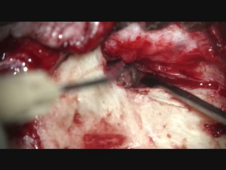 Tympanoplastik von Prof. P. Dolhen